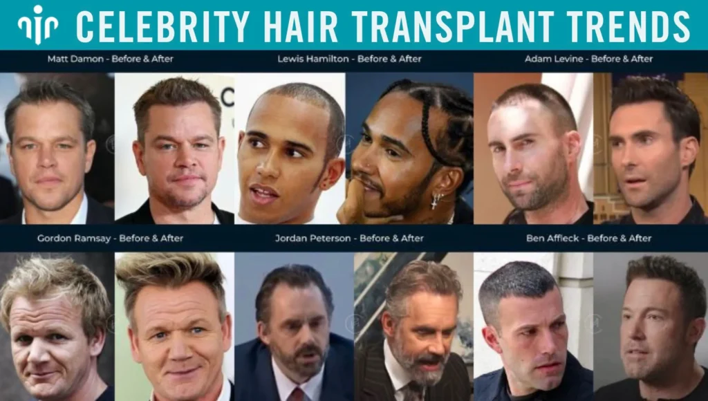Celebrity-Hair-Transplant-Trends (2) Celebrity-Hair-Transplant-Trends