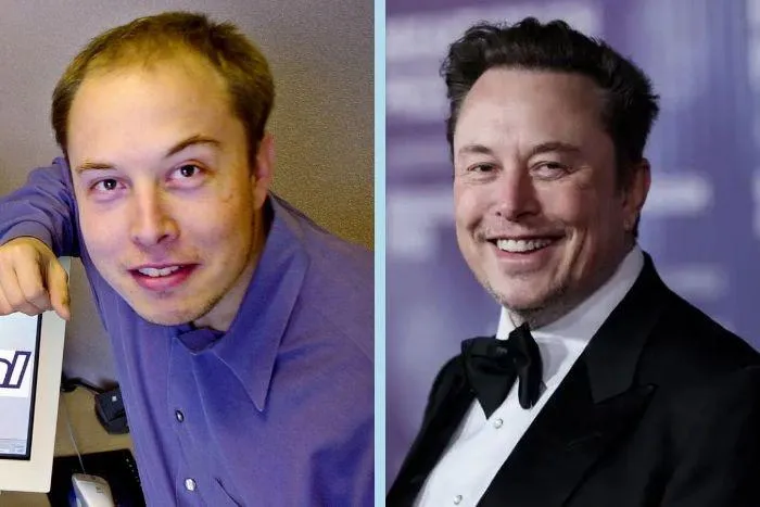 Elon Musk Hair Transplant