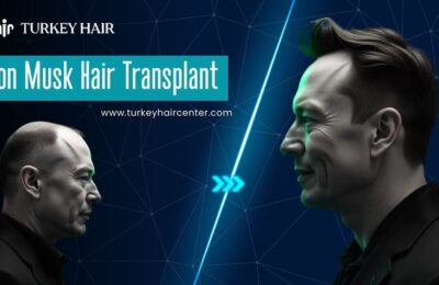 elon musk hair transplant