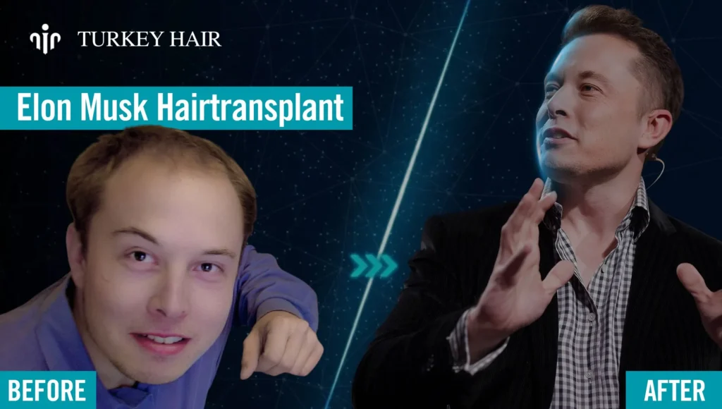 Elon-Musk-Hair-Transplant-Before-After Elon Musk'S Hair Transplant Timeline