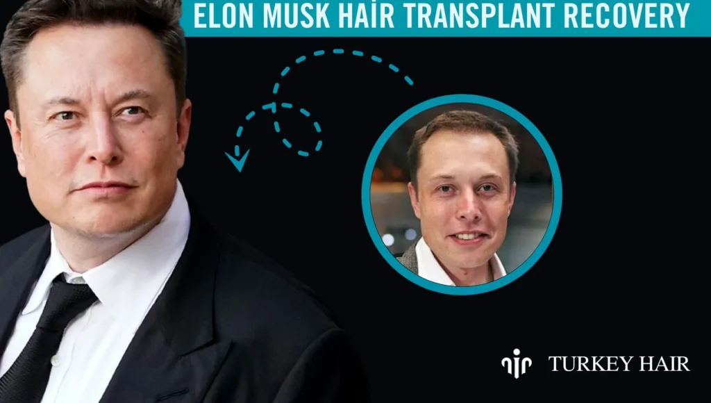 Elon-Musk-Hair-Transplant-Recovery Elon-Musk-Hair-Transplant-Recovery