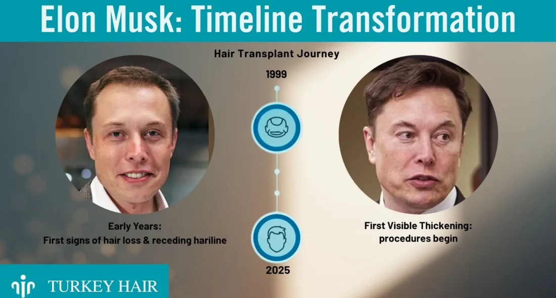 Elon-Musk-Hairline-Timeline Elon-Musk-Hairline-Timeline