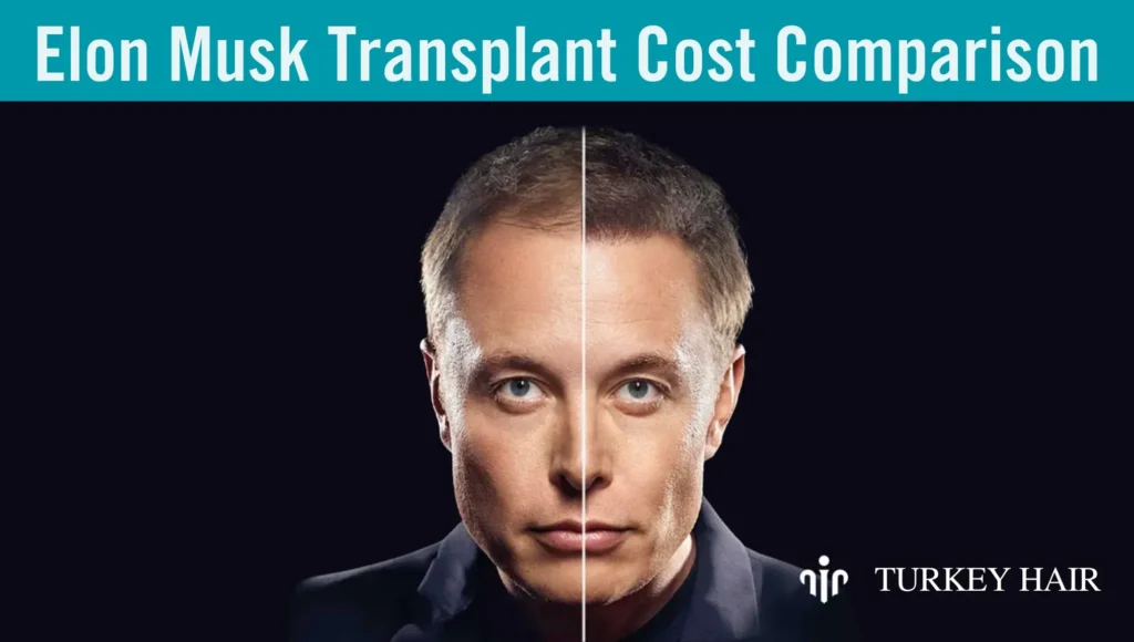 Elon-Musk-Transplant-Cost-Comparison Elon-Musk-Transplant-Cost-Comparison
