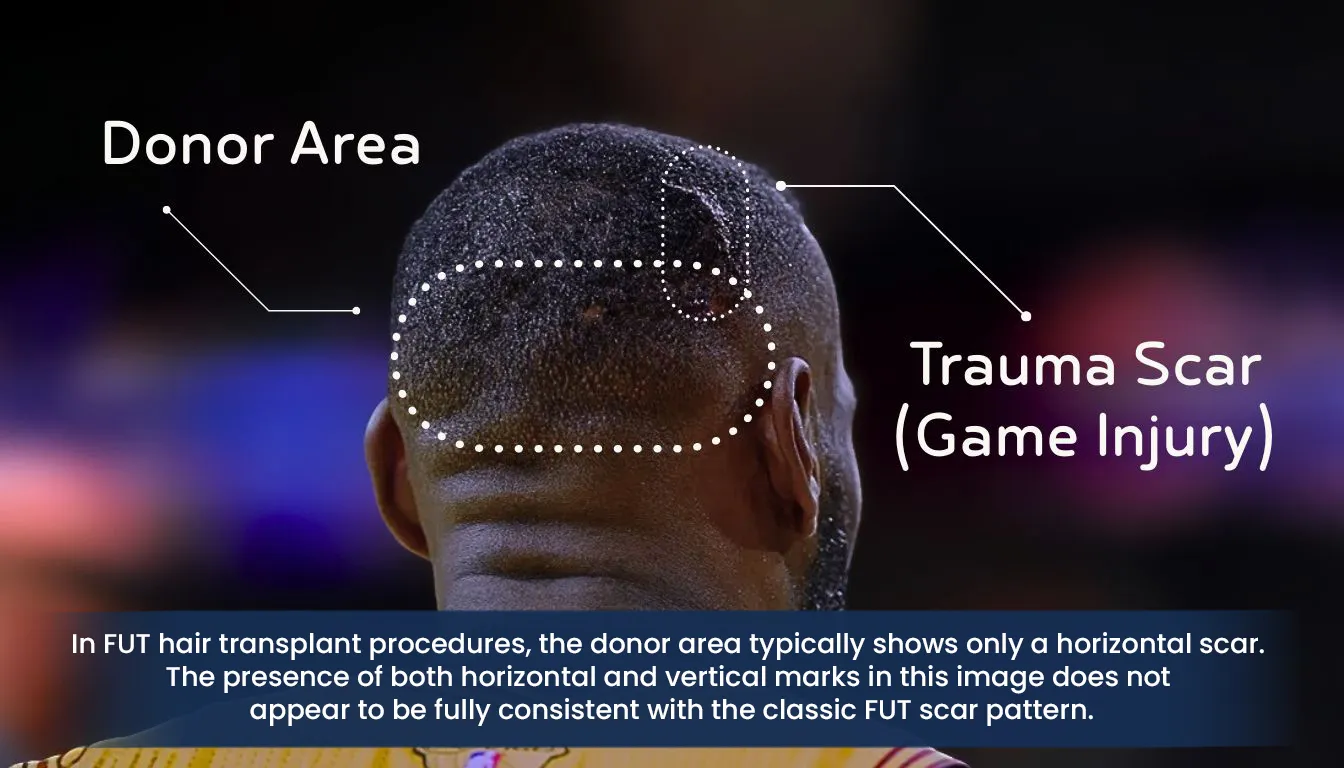 Lebron-James-Donor-Area-Trauma-Scar-Fue-Fut-Analysis Back Of Head Scar Analysis Comparing Trauma Injury And Fue Fut Hair Transplant Scars