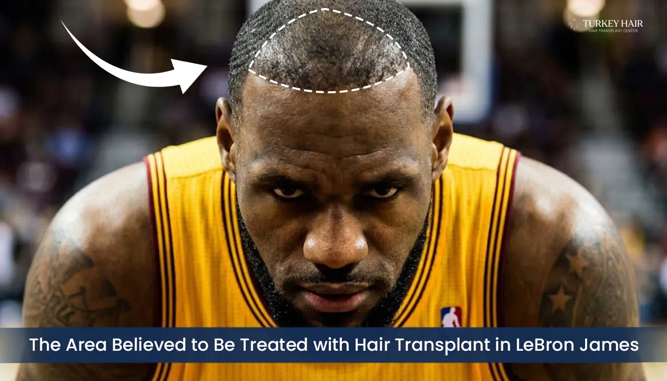 Lebron-James-Frontal-Hairline-Treated-Area-Analysis Frontal Hairline Restoration Area Analysis In Lebron James Hair Transplant Case