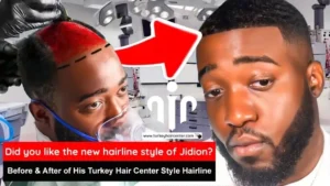 JiDion Hair Transplant