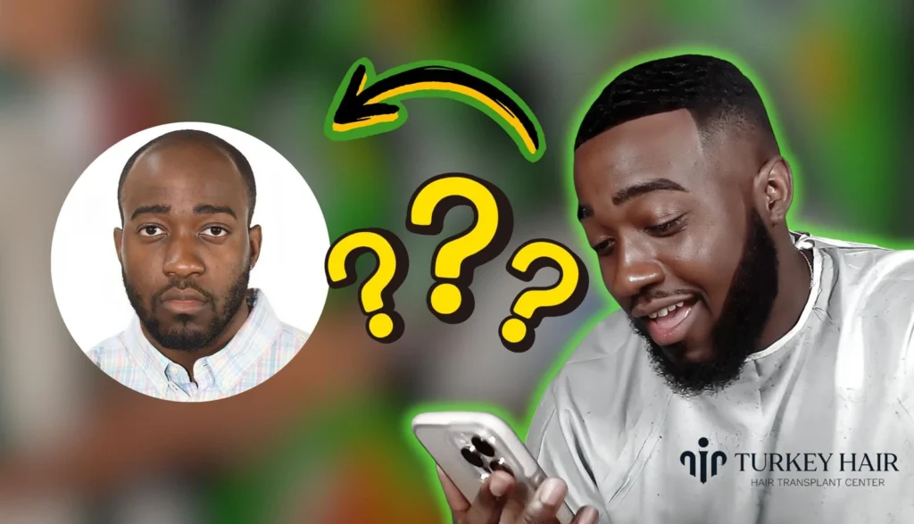 Jidion-Hair-Transplant-Before-After