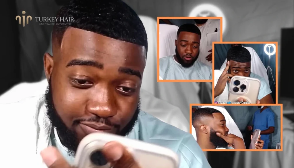 Youtuber Jidion Hair Transplant