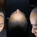 Hair Transplant For Women