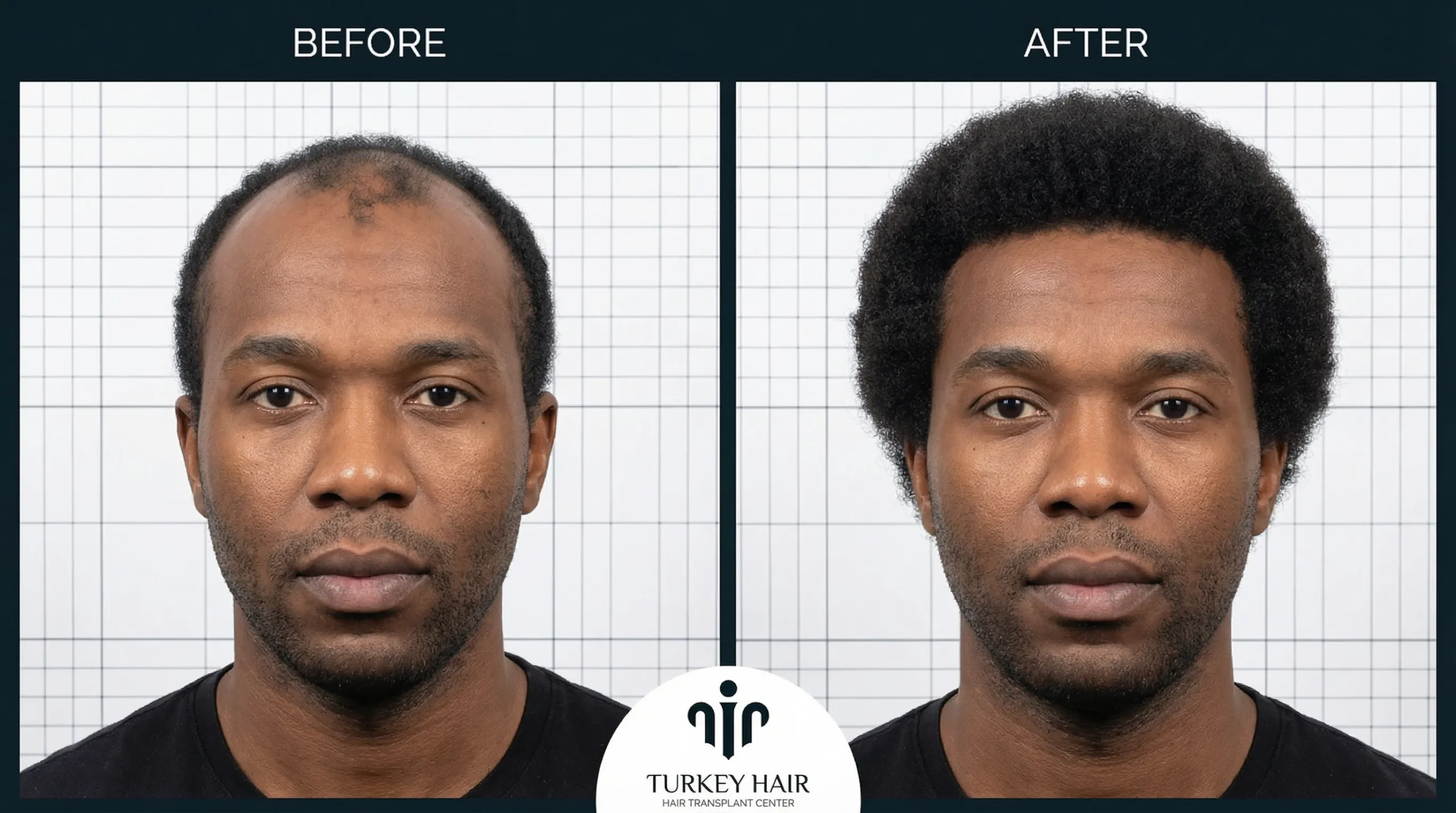 Afro Hair Transplant Before After