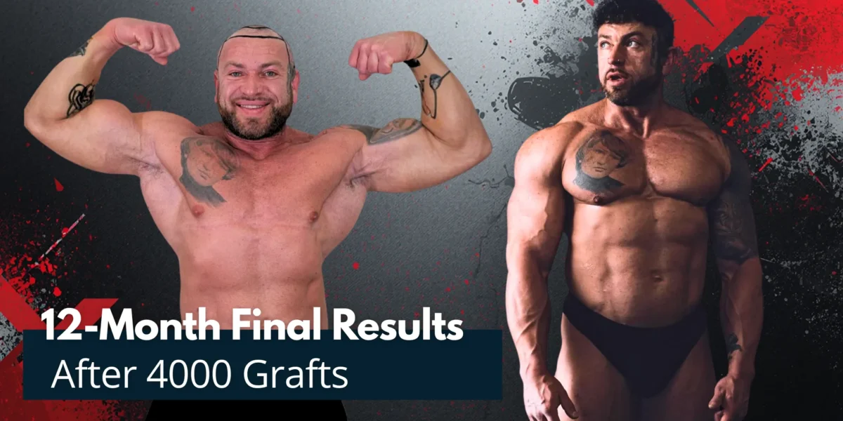 12-Month Final Results After 4000 Grafts 12-Month Final Results After 4000 Grafts