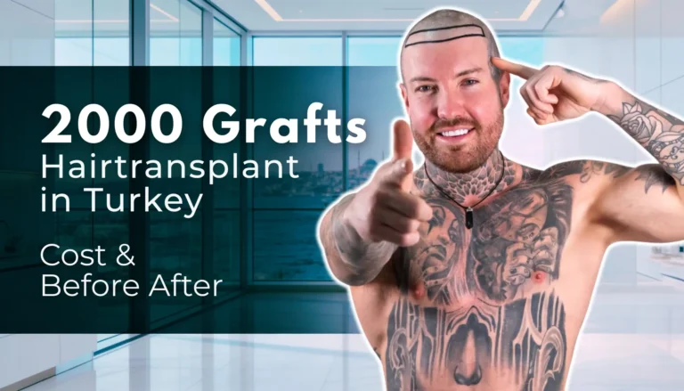 2000 Grafts Hair Transplant In Turkey – Cost &Amp; Before After