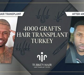 4000 Grafts Hair Transplant Turkey   Cost And Procedure