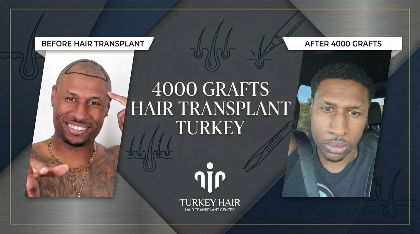 4000 Grafts Hair Transplant Turkey   Cost And Procedure