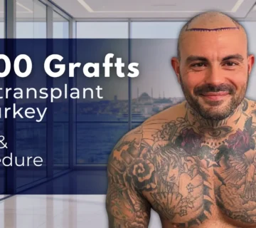 5000 Grafts Hair Transplant Turkey – Cost And Procedure