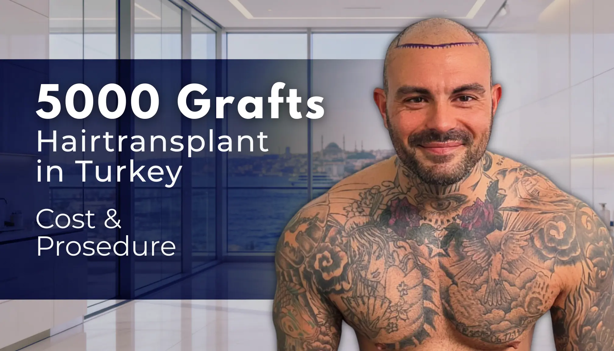 5000 Grafts Hair Transplant Turkey - Cost - Before And After 1 5000 Grafts Hair Transplant Turkey – Cost Before And After