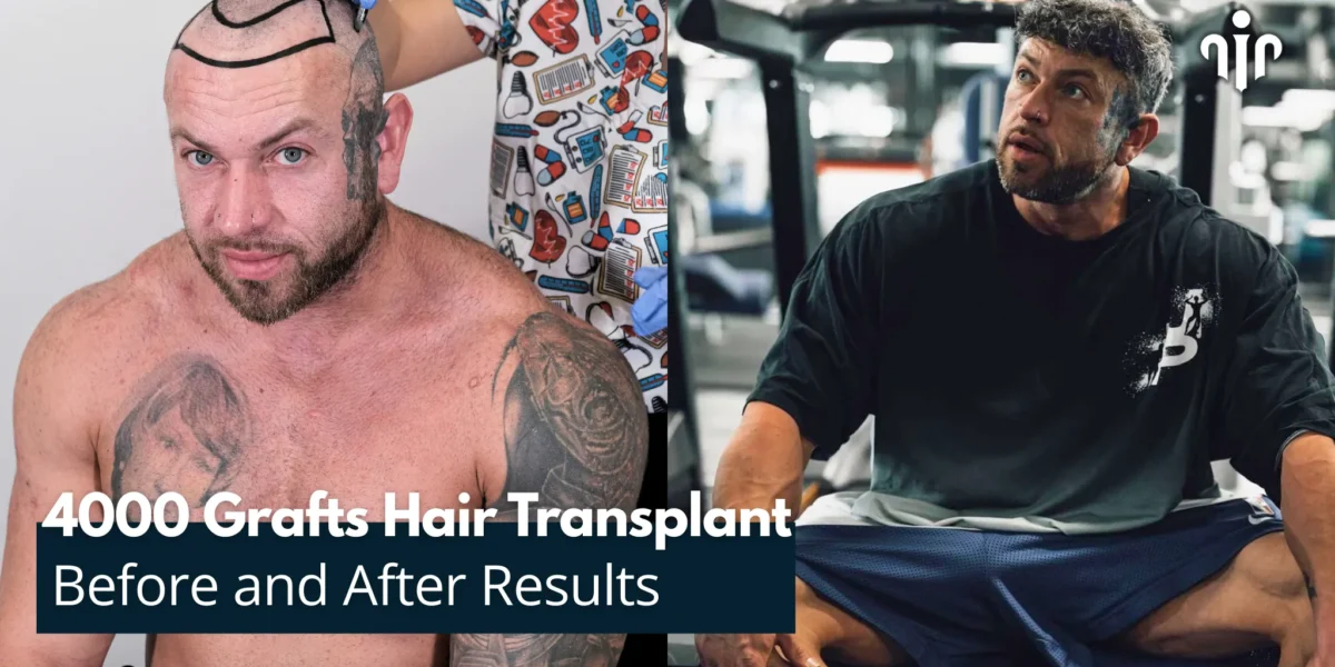 Before And After Results Of 4000 Grafts Hair Transplant Before And After Results Of 4000 Grafts Hair Transplant