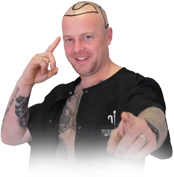 Hairline Design Before Transplant Hairline Drawing On Male Scalp Before Hair Transplant