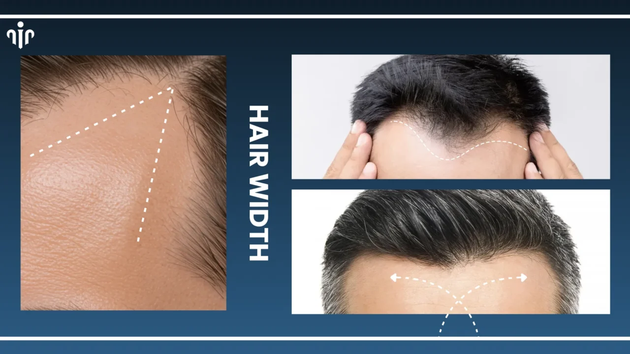 Haircuts By Hairline Type