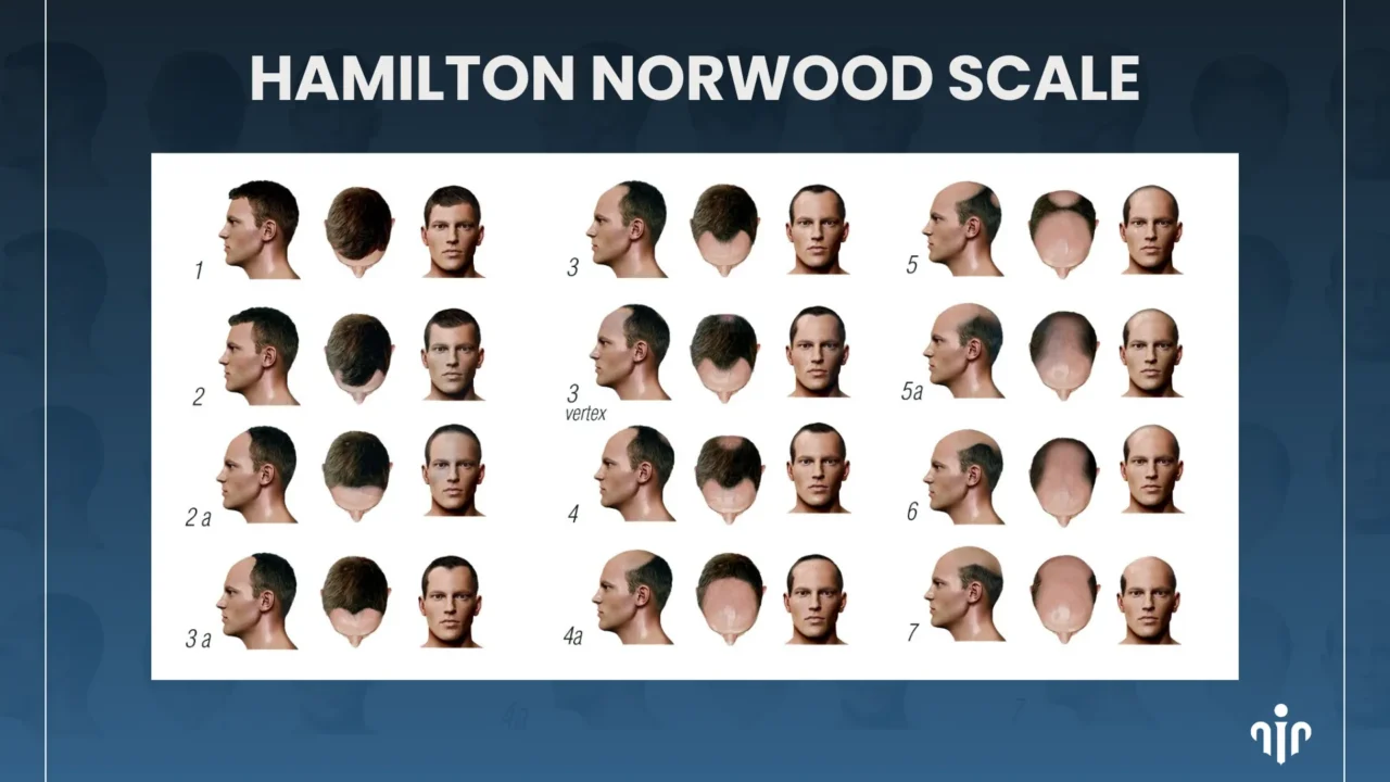 Hairstyles For Advanced Hair Loss