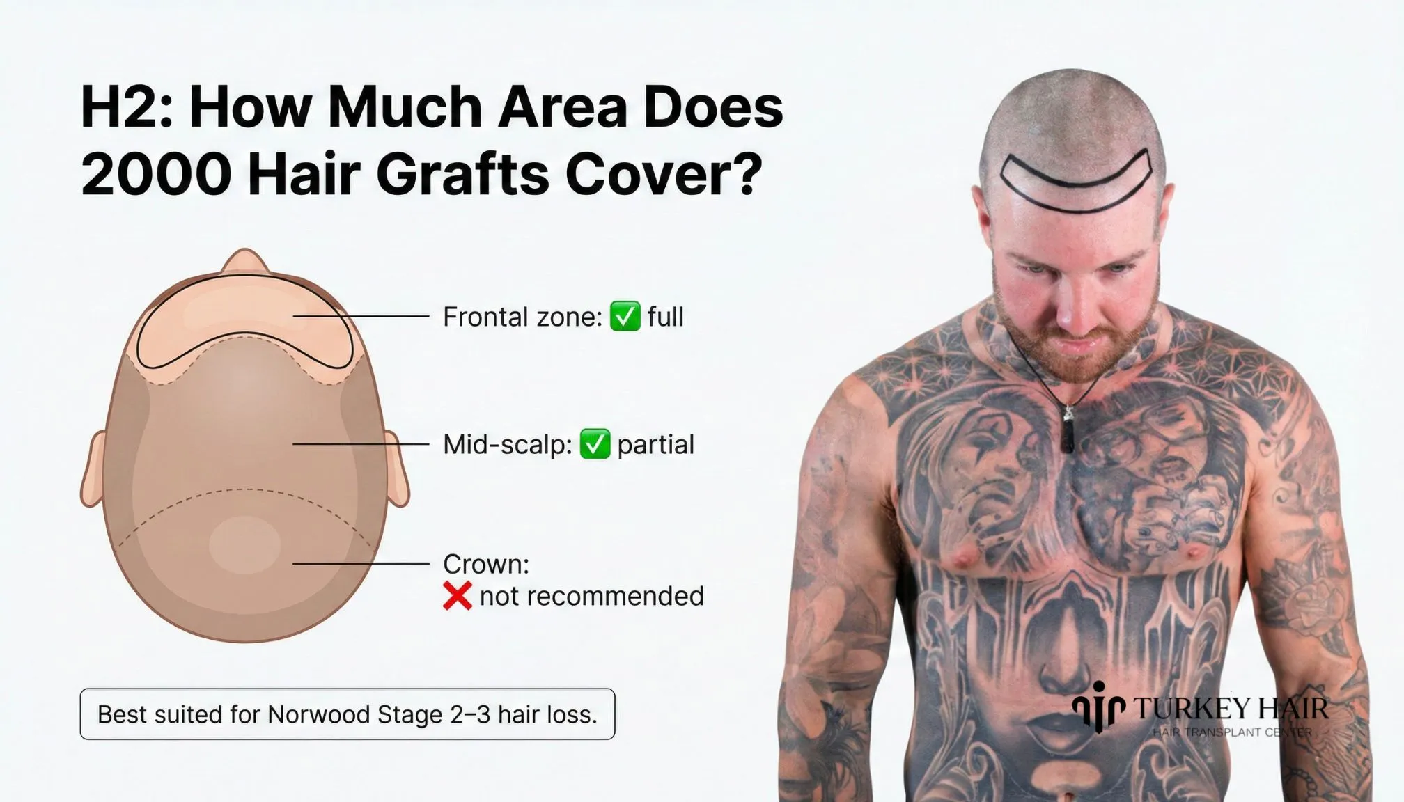 How Much Area Does 2000 Hair Grafts Cover