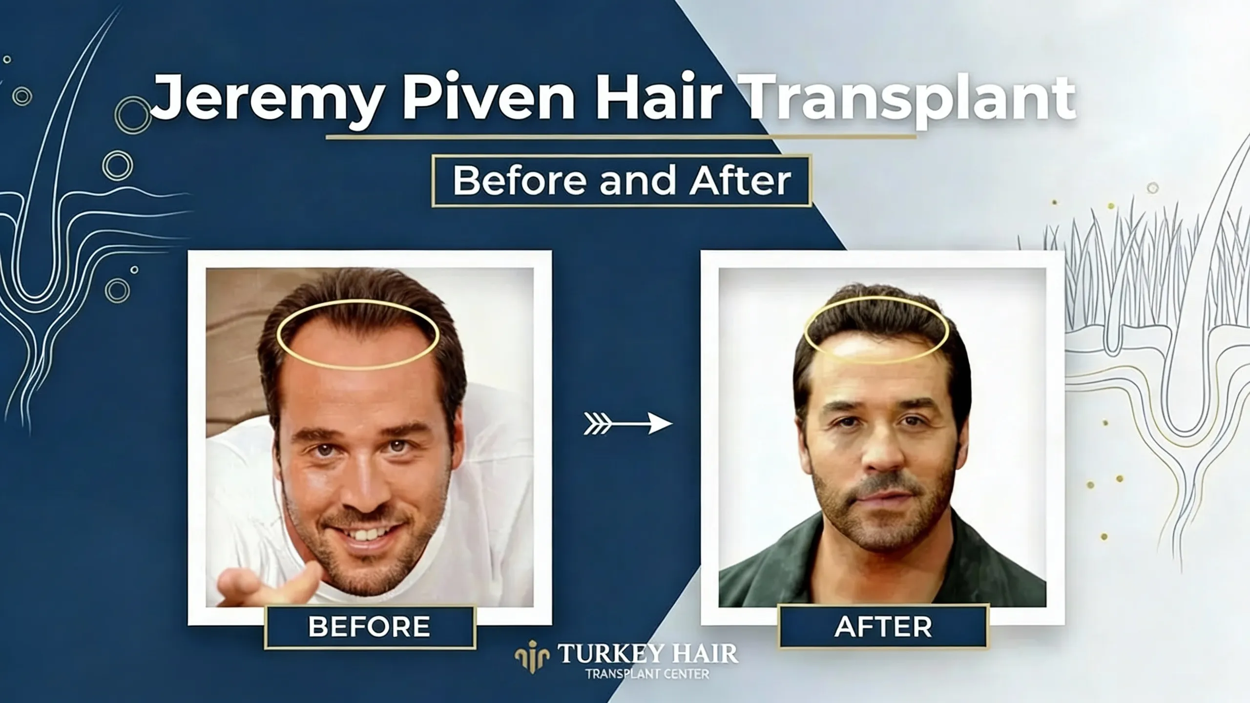 Jeremy Piven Hair Transplant – Before And After 1 Jeremy Piven Hair Transplant – Before And After