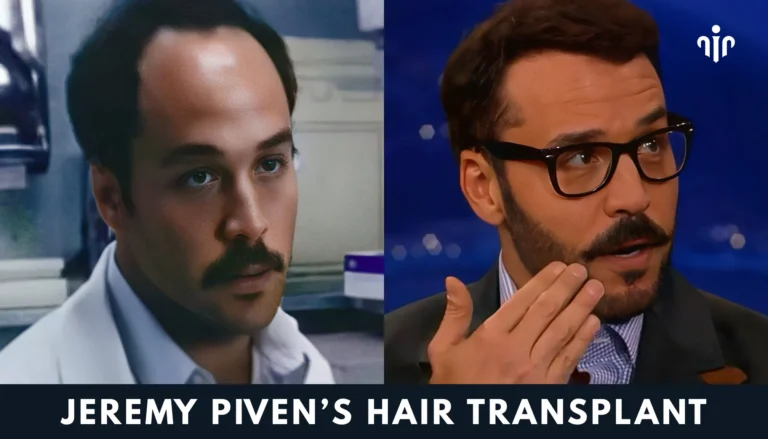 Jeremy Piven Hair Transplant – Before And After