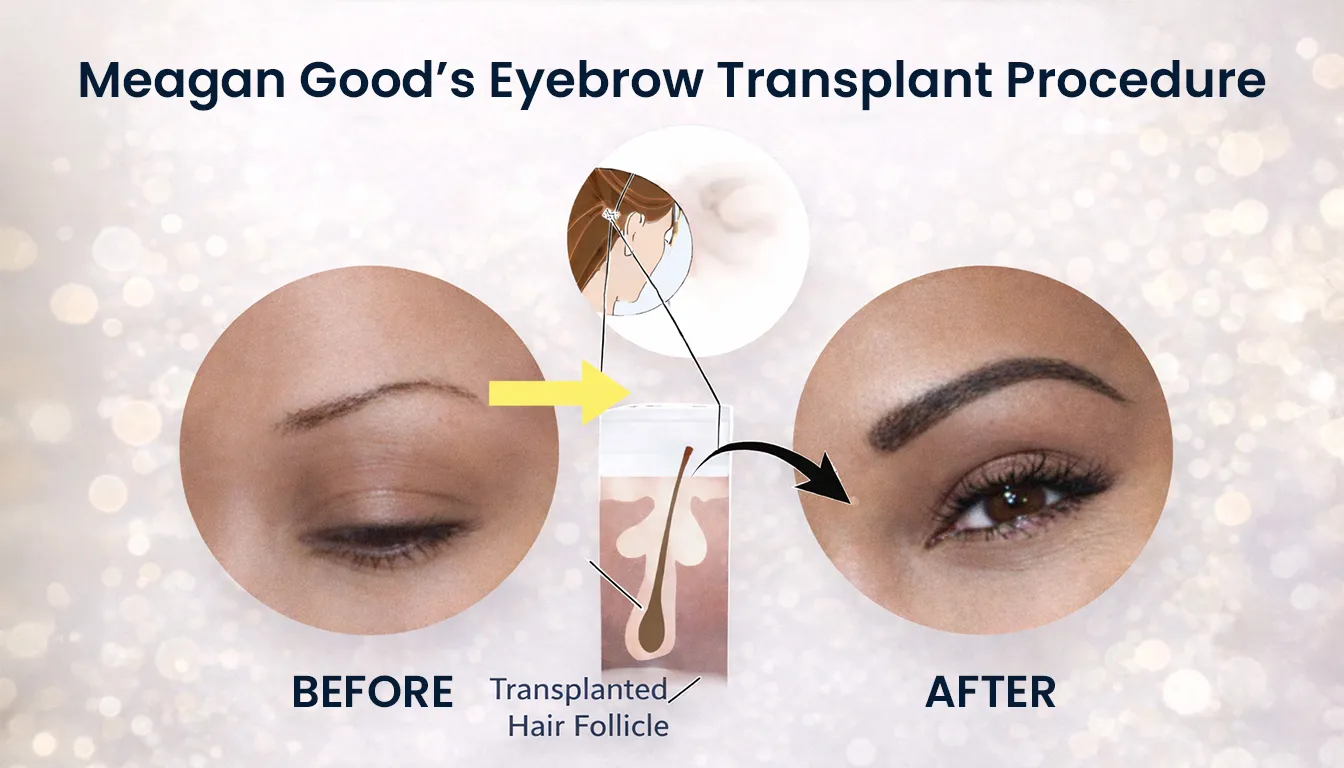Meagan Good Eyebrow Transplant Procedure