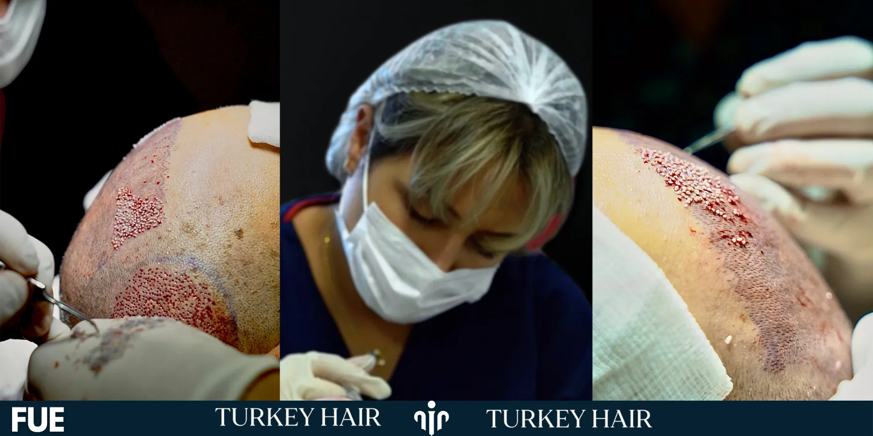 Widow’s Peak Hair Transplant In Turkey – Cost- Before And After 5 Techniques Used For Widow’s Peak Hair Transplant In Turkey