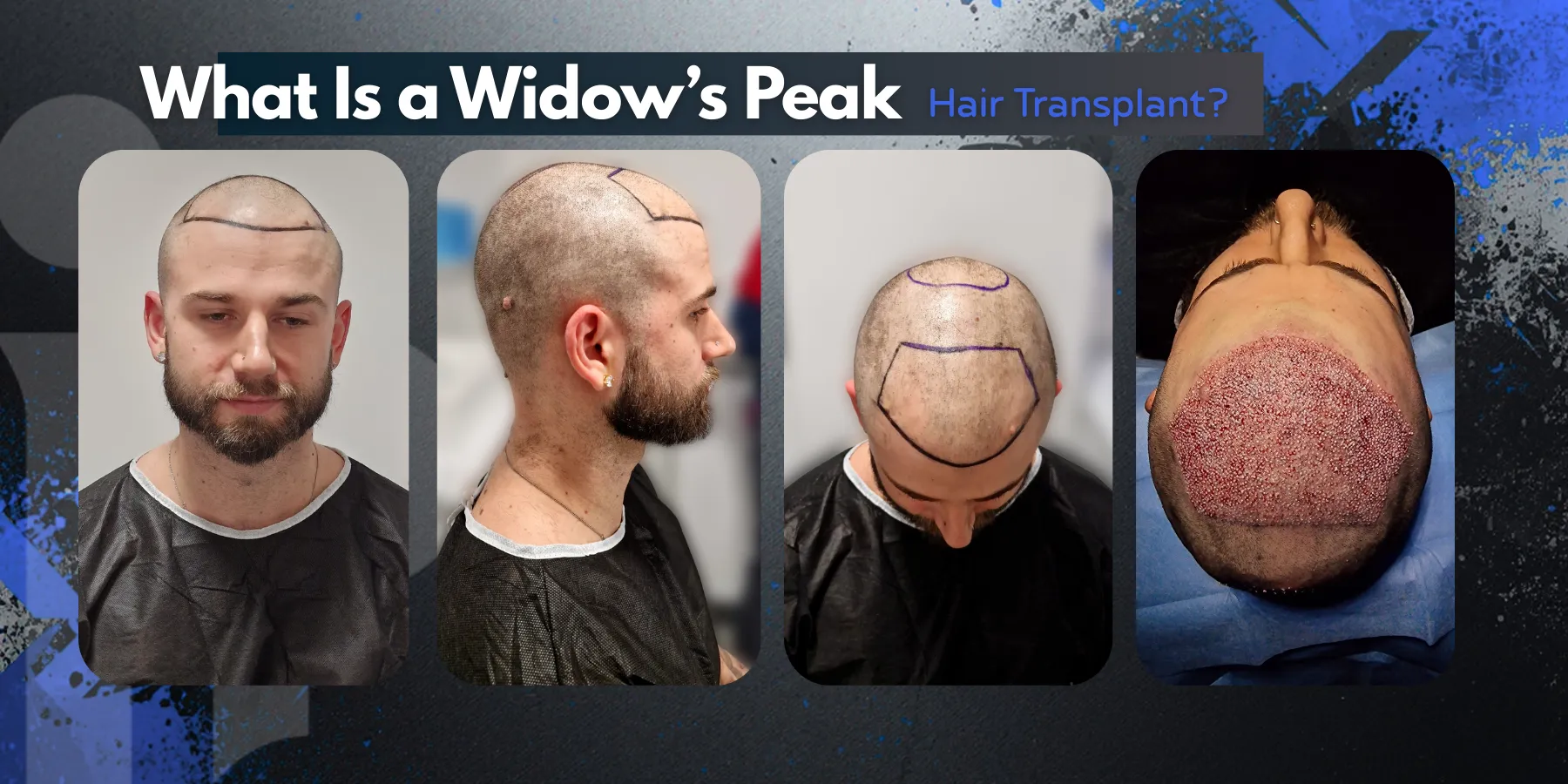 Widow’s Peak Hair Transplant In Turkey – Cost- Before And After 1 Widow’s Peak Hair Transplant In Turkey – Cost Before And After