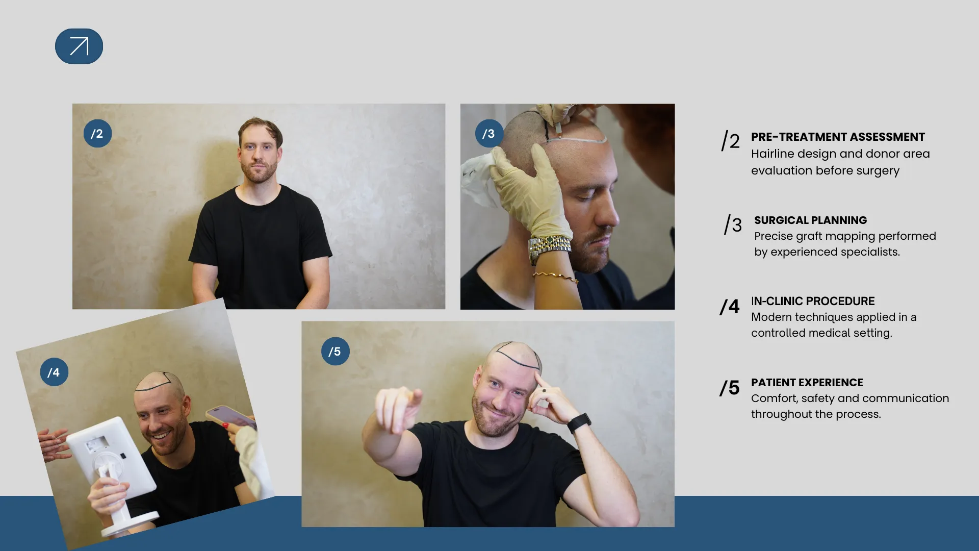 Detailed Comparison About Hair Transplant