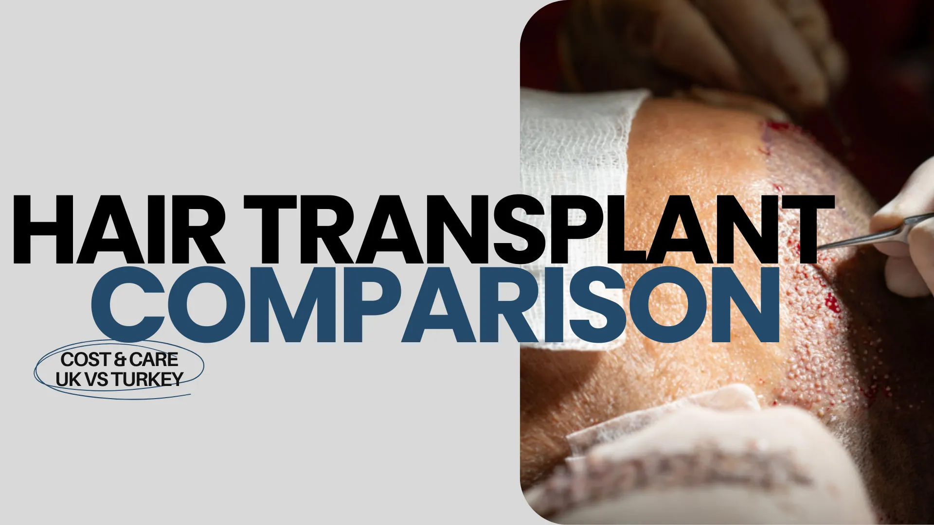 Hair Transplant Results In The Uk And Turkey A Clinical Comparison