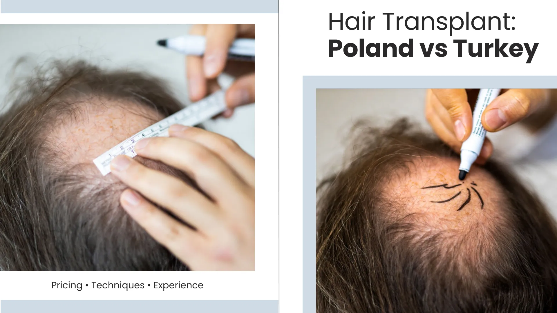 Hair Transplant In Poland Vs Turkey