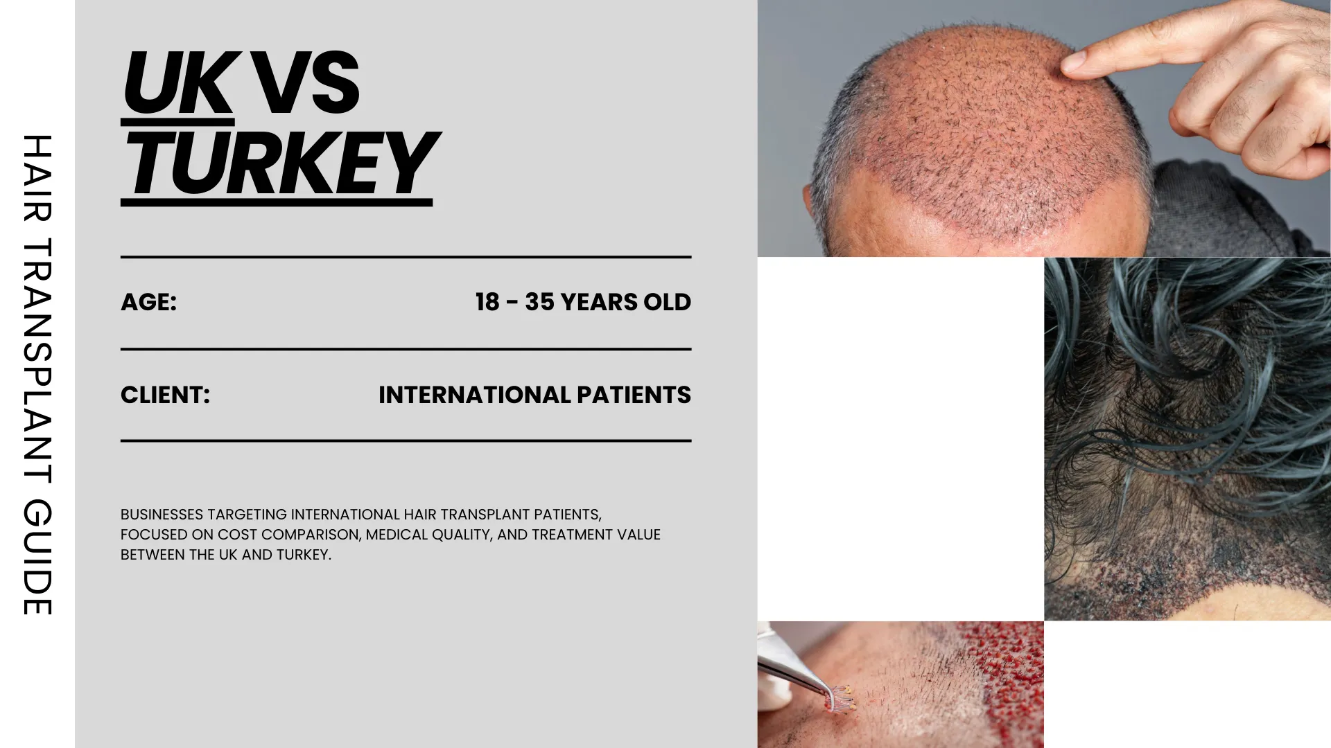 Uk For Hair Transplant Surgery