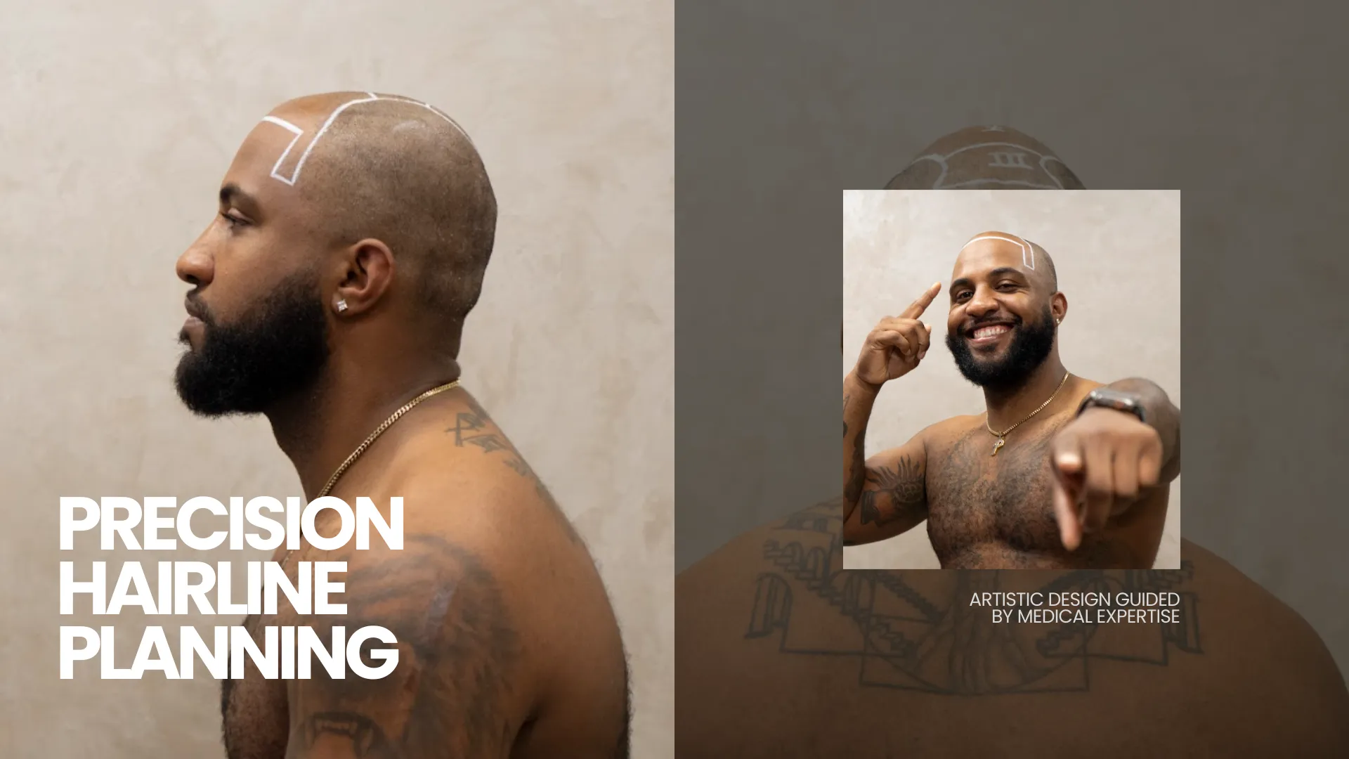 Hairline Planning For Transplant