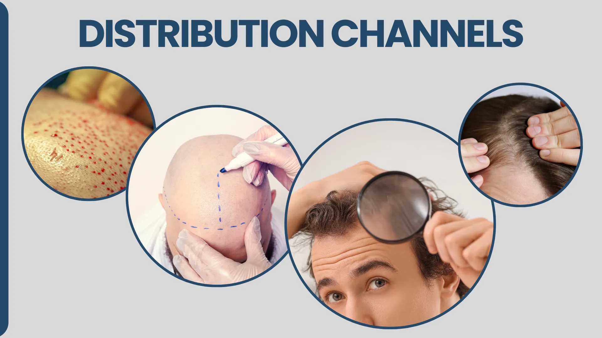 Hair Transplants Donor Are