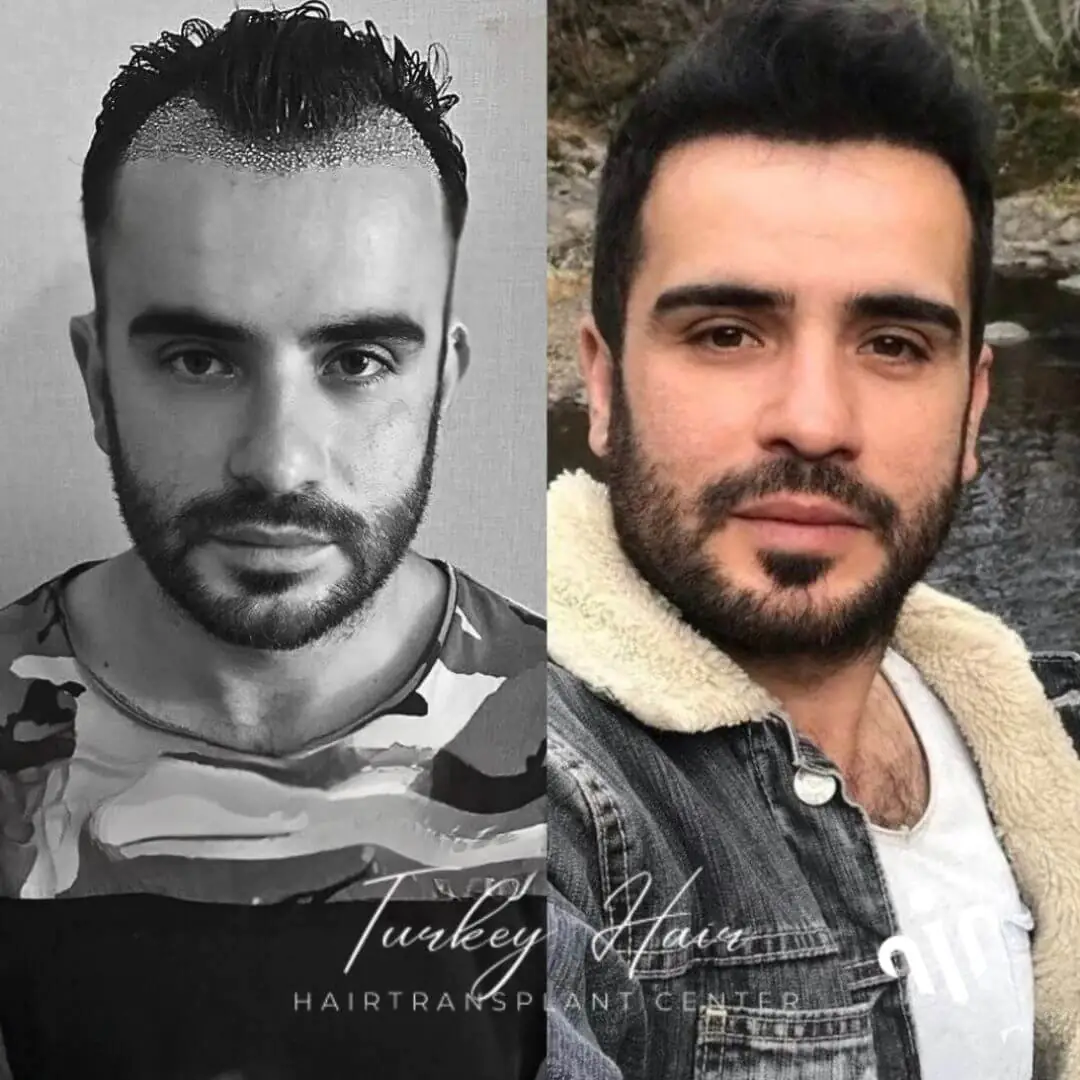 1000-Grafts-Hair-Transplant-Before-After-2.Jpg 1000 Grafts Hair Transplant In Turkey – Cost – Before And After