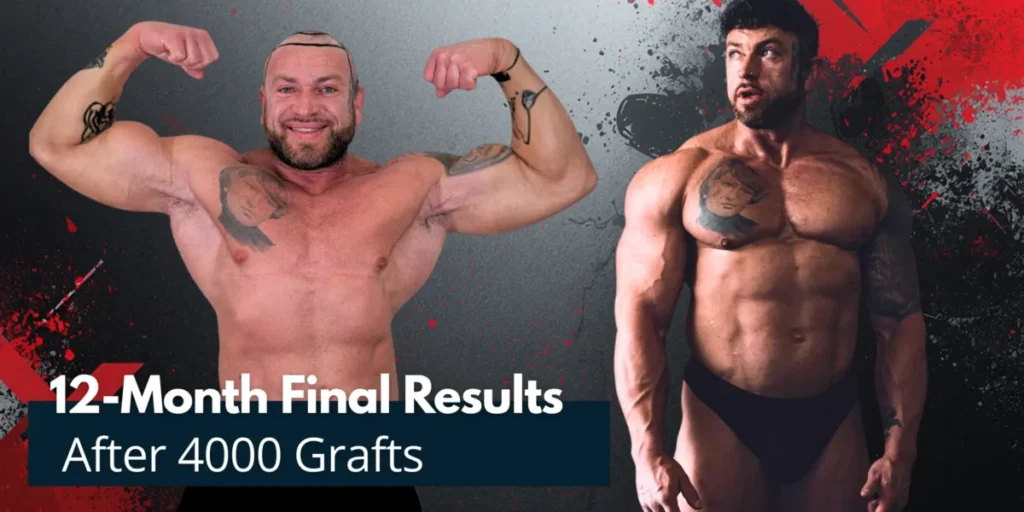12-Month-Final-Results-After-4000-Grafts-1200X600 4000 Grafts Hair Transplant Turkey – Cost And Procedure