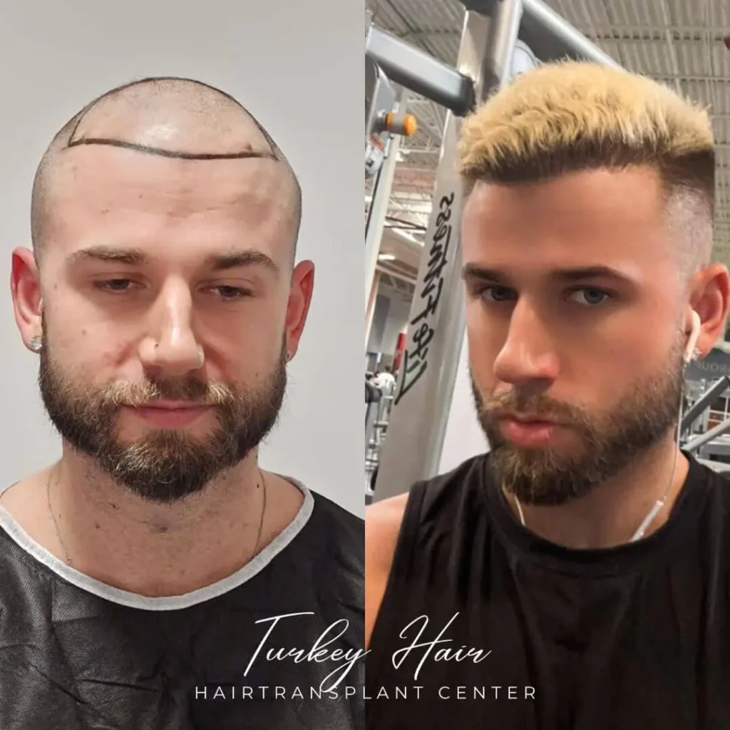 5000-Grafts-Hair-Transplant-Before-After-2.Jpg 5000 Grafts Hair Transplant Turkey – Cost – Before And After