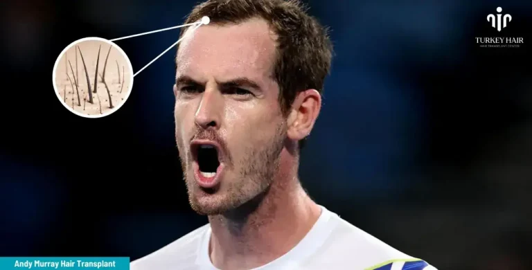 Andy-Murray-Hair-Transplant-2-2-1-768X390 Britain’s Number 1 Tennis Player Andy Murray’s Hair Transplant