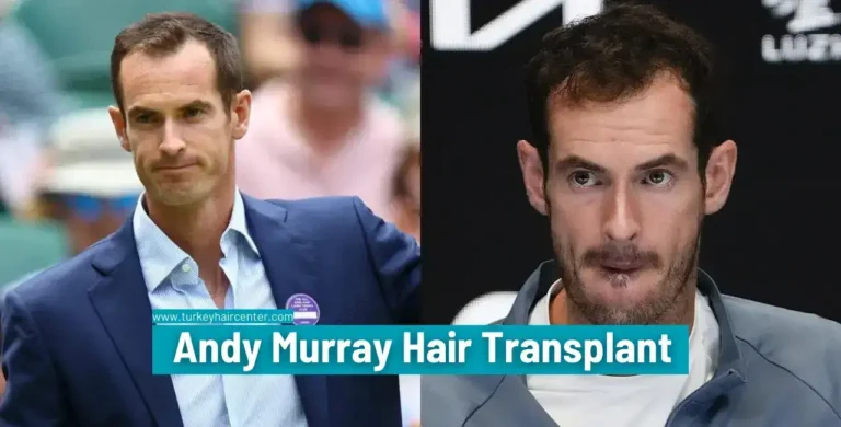 Andy-Murray-Hair-Transplant-7-1-768X390 Britain’s Number 1 Tennis Player Andy Murray’s Hair Transplant