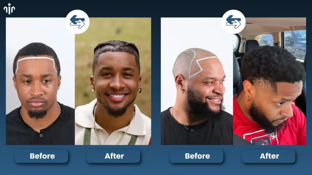 Before-And-After-Hairstyle-Comparisons-1280X720 Top Men’s Hairstyles That Suit Receding Or Balding Hairlines