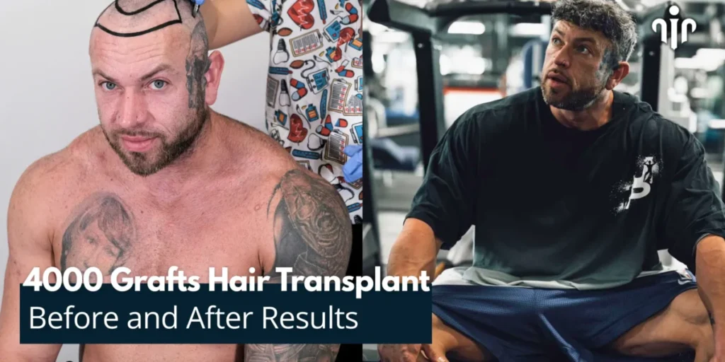 Before-And-After-Results-Of-4000-Grafts-Hair-Transplant-1200X600 4000 Grafts Hair Transplant Turkey – Cost And Procedure