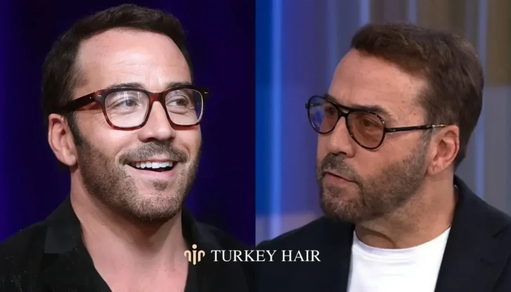 Crown-Area-And-Overall-Density-Changes-1344X768 Jeremy Piven Hair Transplant – Before And After