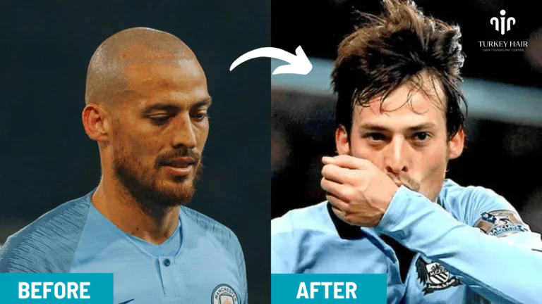 David-Silva-Hair-Transplant-5-768X432.Png Discover David Silva Hair Transplant 2026