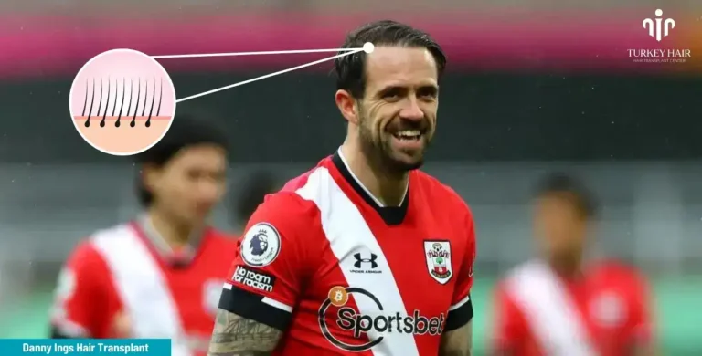Danny-Ings-Hair-Transplant-1-1-768X390 Let’s Discover Succesfull Striker Danny Ings’ Hair Transplant 2026