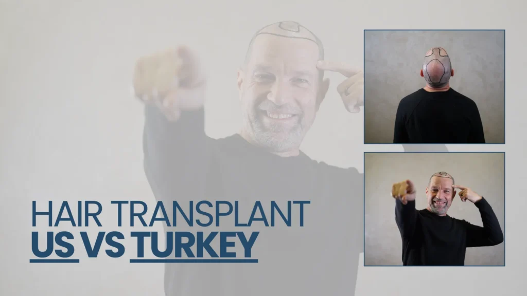 Determine-Hair-Transplant Hair Transplant Us Vs Turkey – Cost, Quality And Key Facts Hair Restoration Excellence You Can Trust