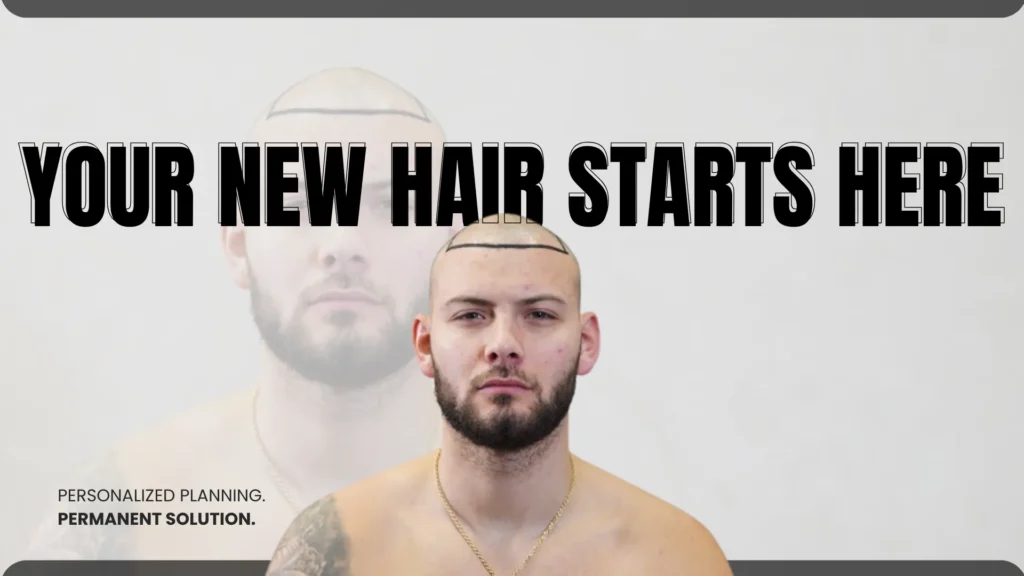 Hair-Transpalant-Turkey-Image Hair Transplant Uk Vs Turkey – Cost, Quality And Key Facts Hair Restoration Excellence You Can Trust