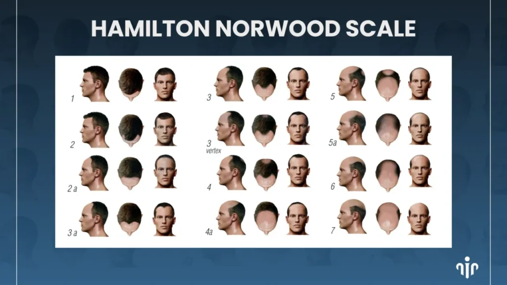 Hairstyles-For-Advanced-Hair-Loss-1280X720 Top Men’s Hairstyles That Suit Receding Or Balding Hairlines