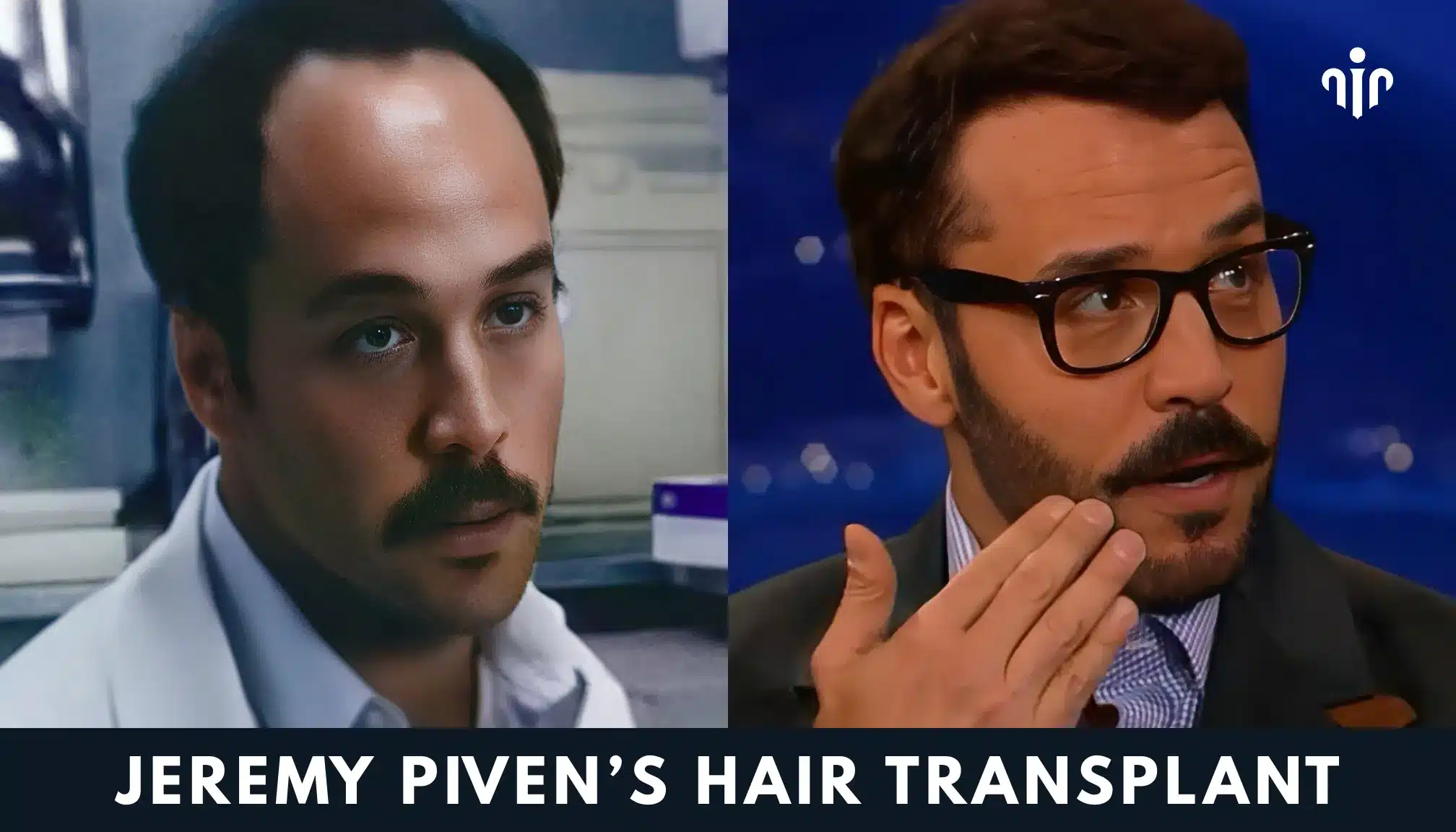 Jeremy Piven – Avant et Après sa greffe de cheveux